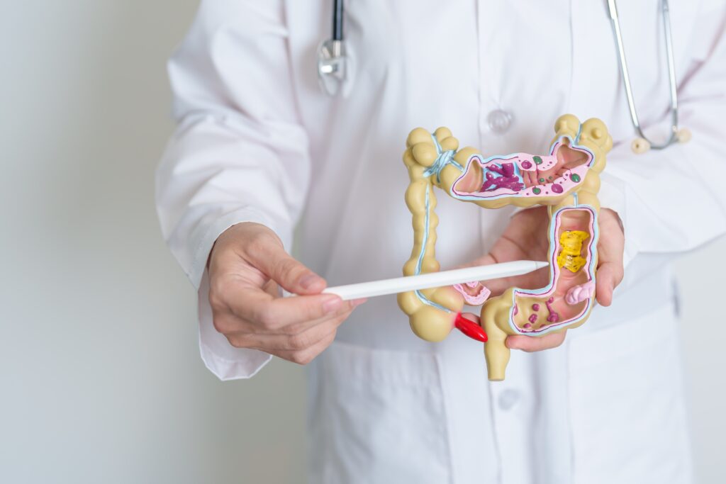 Bowel endometriosis