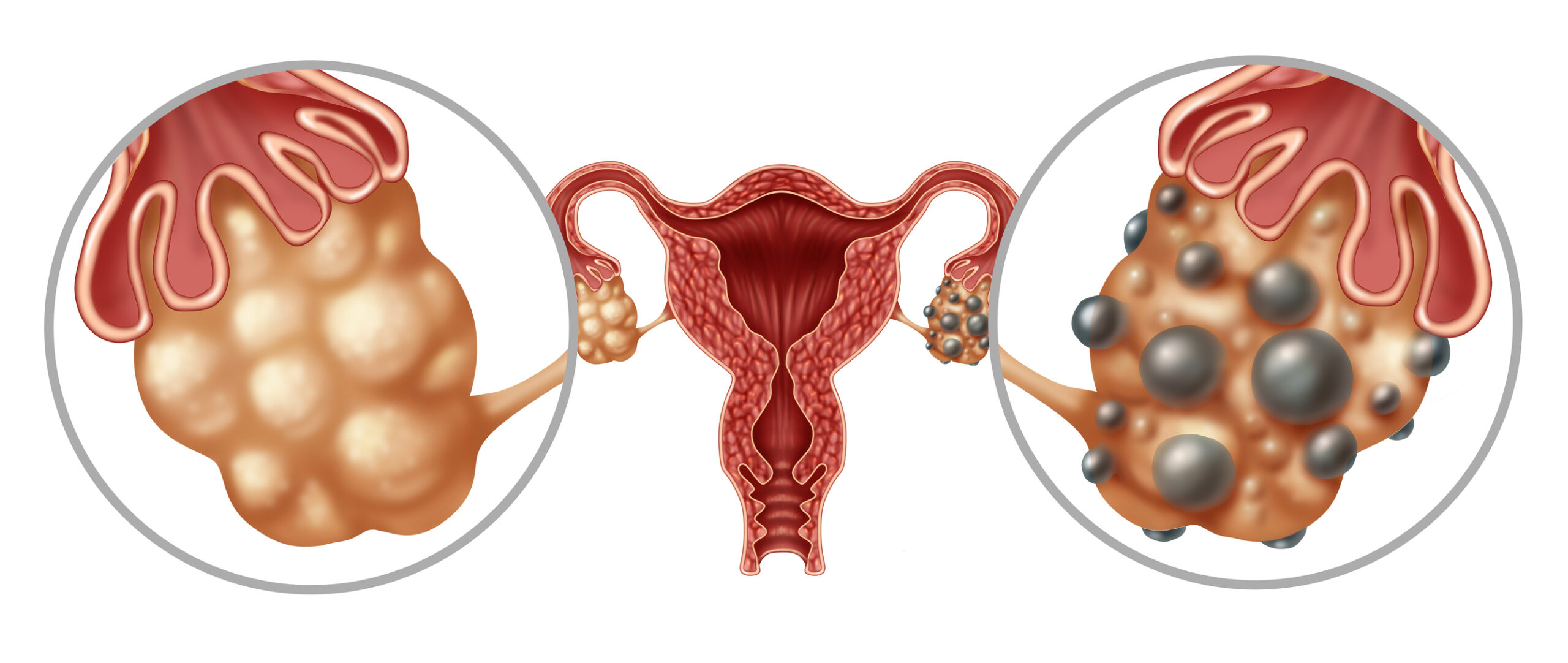 Polycystic Ovarian Syndrome